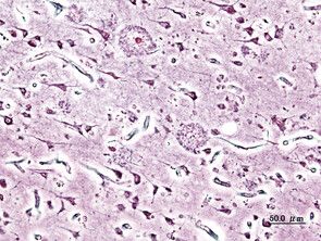 https://cdn.gdch.de/prod/csm_Alzheimer_histopathologisches_Bild_Wiki_55b9e81059_9b2b9a19b9.jpg